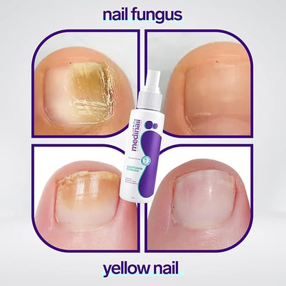 Nail Fungus Remover